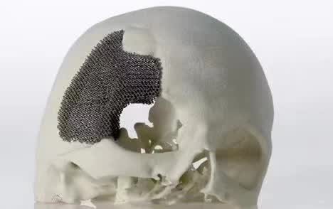 顱骨3D打印技術(shù)是什么？